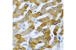 Immunohistochemical analysis of AARS2 staining in human liver cancer formalin fixed paraffin embedded tissue section.