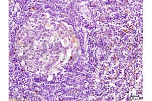 Formalin-fixed human pancreatic cancer tissue labeled with Anti-HLA DMβ Polyclonal Antibody, Unconjugated  at 1:200 followed by conjugation to the secondary antibody and DAB staining (CD74 antibody  (AA 201-296))