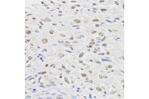 Immunohistochemistry of paraffin-embedded human lung cancer using HMGN1 antibody (ABIN5975005) at dilution of 1/100 (40x lens). (HMGN1 antibody)