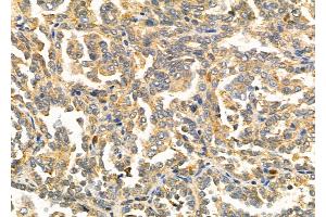 ABIN6257757 and ABIN6275874 at 1/100 staining Human kidney cancer by IHC-P.