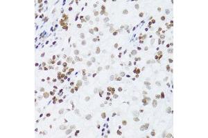 Immunohistochemistry (Paraffin-embedded Sections) (IHC (p)) image for anti-Nuclear Factor of kappa Light Polypeptide Gene Enhancer in B-Cells 2 (NFKB2) (AA 690-899) antibody (ABIN3017388)