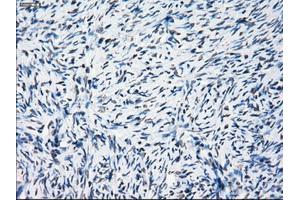 Immunohistochemical staining of paraffin-embedded Adenocarcinoma of breast tissue using anti-PRKY mouse monoclonal antibody. (PRKY antibody)