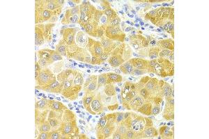 Immunohistochemistry of paraffin-embedded human liver cancer using CYP2E1 antibody at dilution of 1:100 (x400 lens).