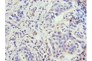 Immunohistochemistry of paraffin-embedded human bladder cancer using ABIN7176493 at dilution of 1:100 (ZNF643 antibody  (AA 15-310))