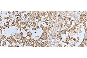 Immunohistochemistry of paraffin-embedded Human colorectal cancer tissue using TREM1 Polyclonal Antibody at dilution of 1:50(x200) (TREM1 antibody)