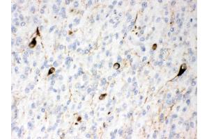 Alpha Internexin was detected in paraffin-embedded sections of human glioma tissues using rabbit anti- Alpha Internexin Antigen Affinity purified polyclonal antibody (Catalog # ) at 1 µg/mL. (INA antibody  (AA 71-161))