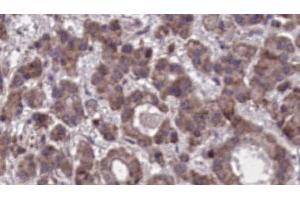 ABIN6273905 at 1/100 staining Human liver cancer tissue by IHC-P. (GPR97 antibody  (N-Term))