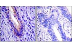 Immunohistochemistry analysis of paraffin-embedded human colon carcinoma tissue, using eIF4G (Ab-1108) Antibody.