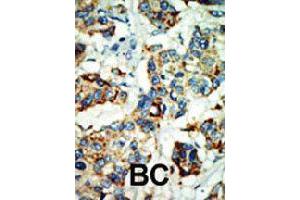 Formalin-fixed and paraffin-embedded human cancer tissue reacted with NEK4 polyclonal antibody  , which was peroxidase-conjugated to the secondary antibody, followed by AEC staining. (NEK4 antibody  (C-Term))
