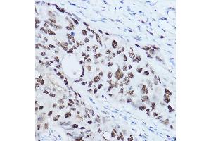 Immunohistochemistry of paraffin-embedded human breast cancer using SSB Rabbit pAb (ABIN3015264, ABIN3015265, ABIN3015266 and ABIN6213909) at dilution of 1:300 (40x lens). (SSB antibody  (AA 166-408))