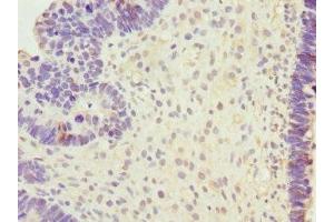 Immunohistochemistry of paraffin-embedded human ovarian cancer using ABIN7168591 at dilution of 1:100 (SAP30BP antibody  (AA 1-308))