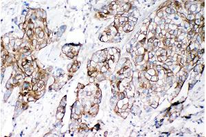 Anti-VE Cadherin antibody, IHC(P) IHC(P): Human Lung Cancer Tissue (Cadherin 5 antibody  (C-Term))