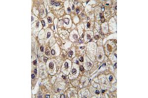 Formalin-fixed and paraffin-embedded human hepatocarcinoma tissue reacted with CYP2C9 antibody (Center), which was peroxidase-conjugated to the secondary antibody, followed by DAB staining. (CYP2C9 antibody  (AA 235-265))
