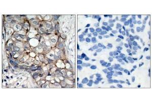 Immunohistochemical analysis of paraffin- embedded human breast carcinoma tissue using (EGFR antibody)