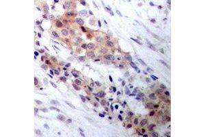 Immunohistochemical analysis of CRY1 staining in human breast cancer formalin fixed paraffin embedded tissue section. (CRY1 antibody)