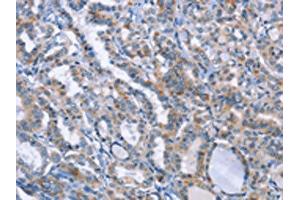The image on the left is immunohistochemistry of paraffin-embedded Human thyroid cancer tissue using (LRRK2 Antibody) at dilution 1/20, on the right is treated with fusion protein.