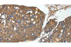 Immunohistochemistry of paraffin-embedded Human breast cancer using MSN Polyclonal Antibody at dilution of 1:30 (Moesin antibody)