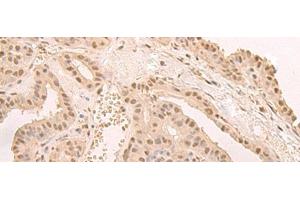 Immunohistochemistry of paraffin-embedded Human thyroid cancer tissue using CNOT10 Polyclonal Antibody at dilution of 1:50(x200) (CNOT10 antibody)