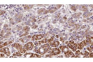 ABIN6272371 at 1/100 staining Human liver cancer tissue by IHC-P. (OR2C3 antibody)