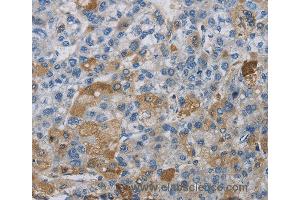 Immunohistochemistry of Human liver cancer using DNAJB4 Polyclonal Antibody at dilution of 1:50