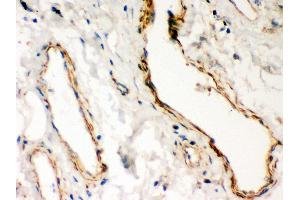 Anti- Dystrophin Picoband antibody, IHC(P) IHC(P): Human Lung Cancer Tissue (Dystrophin antibody  (AA 3076-3404))