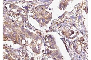 ABIN6269037 at 1/100 staining Human breast cancer tissue by IHC-P. (EPH Receptor A4 antibody  (Internal Region))