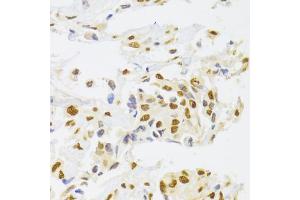 Immunohistochemistry of paraffin-embedded human breast cancer using HNRNPA1 Antibody (ABIN5975570) at dilution of 1/100 (40x lens). (HNRNPA1 antibody)