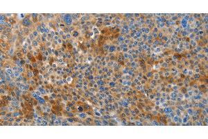 Immunohistochemistry of paraffin-embedded Human liver cancer tissue using HTRA3 Polyclonal Antibody at dilution 1:45 (HTRA3 antibody)