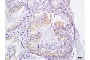 Formalin-fixed and paraffin embedded human gastric cancer  labeled with Anti-VEGFR3 Polyclonal Antibody, unconjugated  (ABIN678578) at 1: 200 followed by incubation with conjugated secondary antibody and DAB staining (FLT4 antibody  (AA 901-1000))
