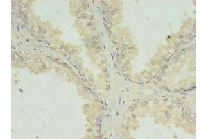 Immunohistochemistry of paraffin-embedded human prostate cancer using ABIN7156699 at dilution of 1:100 (PRKRA antibody  (AA 1-313))