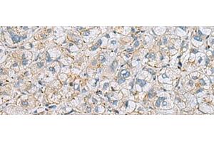 Immunohistochemistry of paraffin-embedded Human liver cancer tissue using MTHFD2 Polyclonal Antibody at dilution of 1:65(x200) (MTHFD2 antibody)