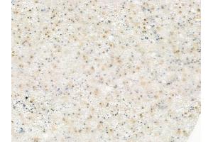 ABIN6256440 and ABIN6267350 at 1/100 staining human astrocytoma by IHC-P.