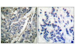 Immunohistochemical analysis of paraffin-embedded human breast carcinoma tissue using Synaptotagmin (phospho-Thr202) antibody (left)or the same antibody preincubated with blocking peptide (right). (SYT1 antibody  (pThr202))