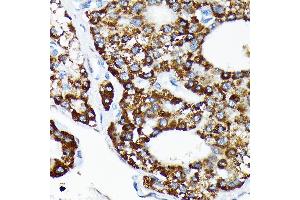 Immunohistochemistry of paraffin-embedded human liver cancer using HSP Rabbit mAb (ABIN7267580) at dilution of 1:100 (40x lens). (HSPA4 antibody)