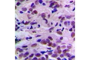 Immunohistochemical analysis of CDK2 (pT160) staining in human breast cancer formalin fixed paraffin embedded tissue section.