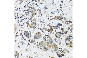 Immunohistochemistry of paraffin-embedded human breast cancer using SSBP1 antibody (ABIN5974202) at dilution of 1/100 (40x lens). (SSBP1 antibody)