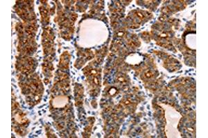 The image on the left is immunohistochemistry of paraffin-embedded Human thyroid cancer tissue using ABIN7130808(RAMP1 Antibody) at dilution 1/10, on the right is treated with fusion protein. (RAMP1 antibody)