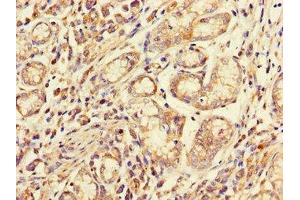 Immunohistochemistry of paraffin-embedded human gastric cancer using ABIN7158537 at dilution of 1:100