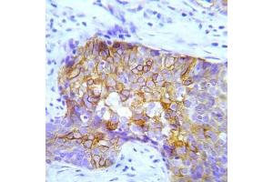 Immunohistochemical analysis of paraffin-embedded human lung adenocarcinoma tissue using Crk2 (Phospho-Try221) Antibody (E012070). (CDK6 antibody  (pTry221))