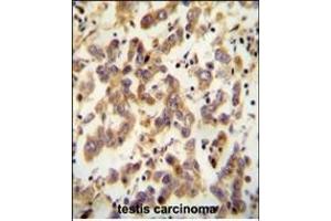 C antibody (Center) (ABIN654782 and ABIN2844463) immunohistochemistry analysis in formalin fixed and paraffin embedded human testis carcinoma followed by peroxidase conjugation of the secondary antibody and DAB staining. (C20ORF173 antibody  (AA 48-76))
