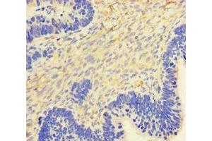 Immunohistochemistry of paraffin-embedded human ovarian cancer using ABIN7154402 at dilution of 1:100 (GM-CSF antibody  (AA 18-144))
