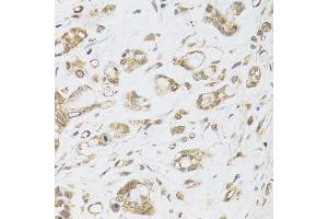 Immunohistochemistry of paraffin-embedded human gastric cancer using DMAP1 antibody (ABIN6003515) at dilution of 1/100 (40x lens).