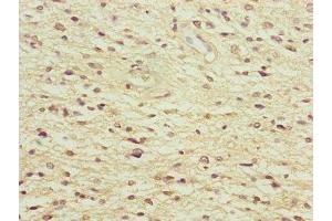 Immunohistochemistry of paraffin-embedded human glioma using ABIN7165859 at dilution of 1:100