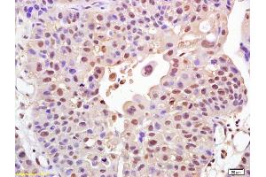 Formalin-fixed and paraffin embedded human bladder carcinoma labeled with Rabbit Anti FOXO1A Polyclonal Antibody, Unconjugated (ABIN1387620) at 1:200 followed by conjugation to the secondary antibody and DAB staining (FOXO1 antibody  (AA 165-270))