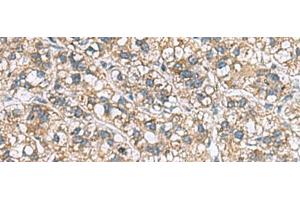 Immunohistochemistry of paraffin-embedded Human liver cancer tissue using MRPL22 Polyclonal Antibody at dilution of 1:60(x200) (MRPL22 antibody)