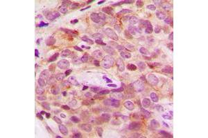 Immunohistochemical analysis of PGHS-2 staining in human breast cancer formalin fixed paraffin embedded tissue section.