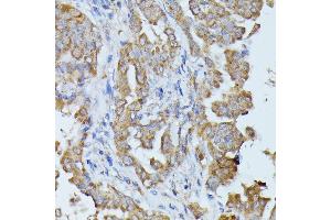 Immunohistochemistry of paraffin-embedded human thyroid cancer using HAL antibody (ABIN6130467, ABIN6141593, ABIN6141594 and ABIN6216851) at dilution of 1:100 (40x lens). (HAL antibody  (AA 1-200))