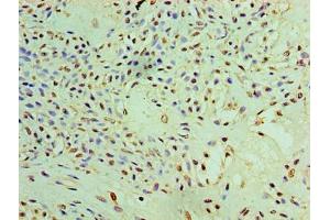Immunohistochemistry of paraffin-embedded human breast cancer using ABIN7166888 at dilution of 1:100 (PYCR1 antibody  (AA 2-319))