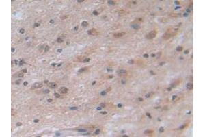 IHC-P analysis of Human Glioma Tissue, with DAB staining. (NOTCH4 antibody  (AA 1715-2001))