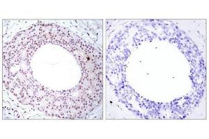 Immunohistochemical analysis of paraffin-embedded human breast carcinoma tissue using NFkB-p65(Phospho-Thr254) Antibody(left) or the same antibody preincubated with blocking peptide(right). (NF-kB p65 antibody  (pThr254))